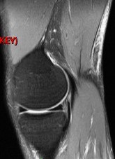 Figure 5 for case Semitendinosus tendon tear, retracted( RID2717 )